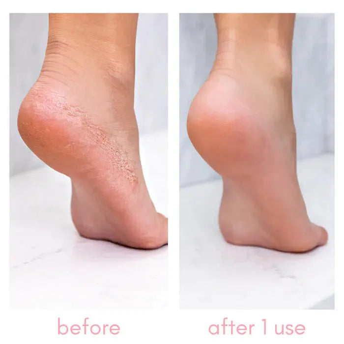 Kiara Sky Heel-ing Callus Remover